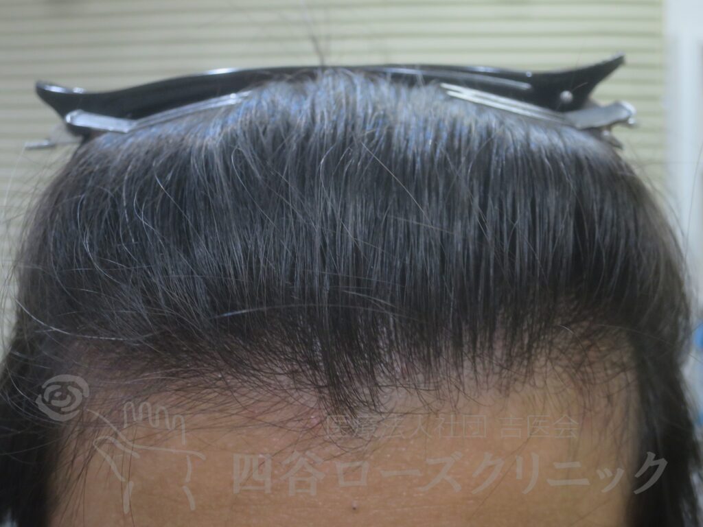 生え際の後退・前 治療後