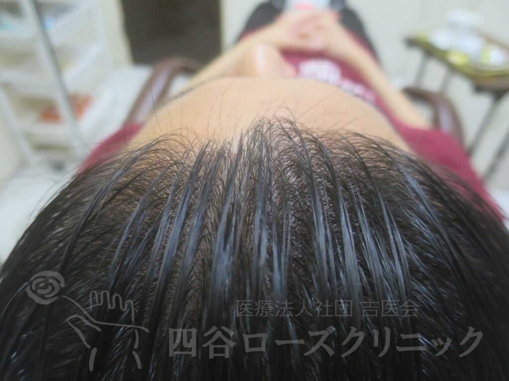 生え際の後退・上 治療後