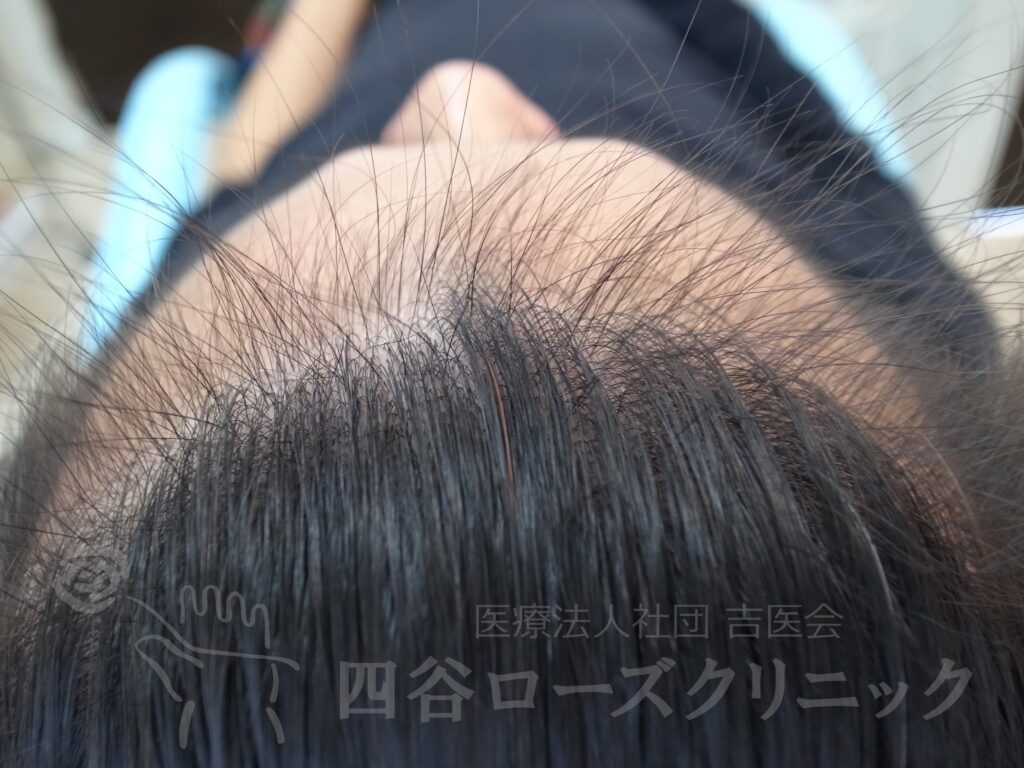 生え際の後退・上 治療前