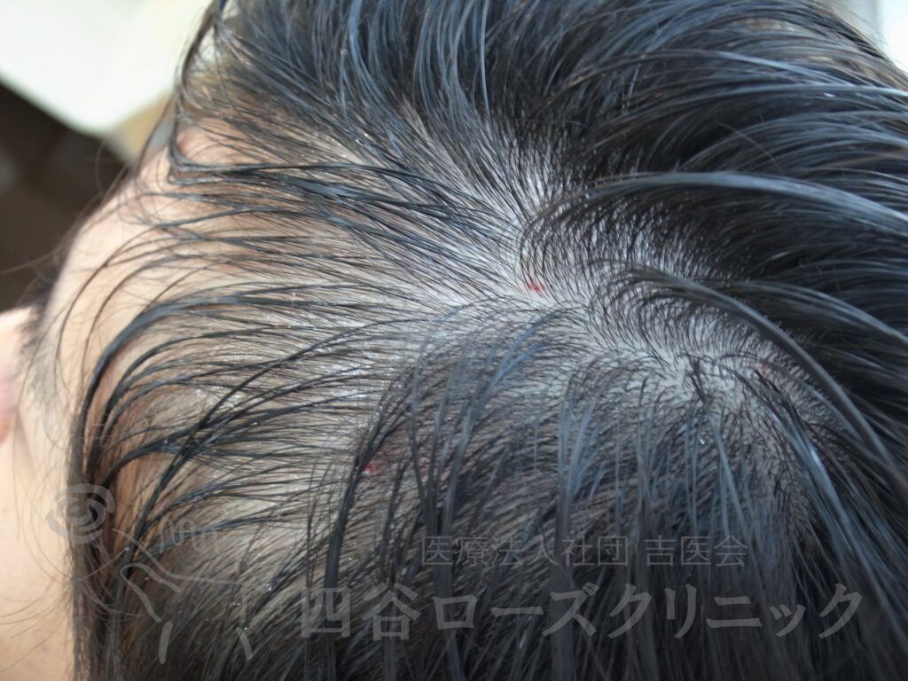 M字の食込み 治療前