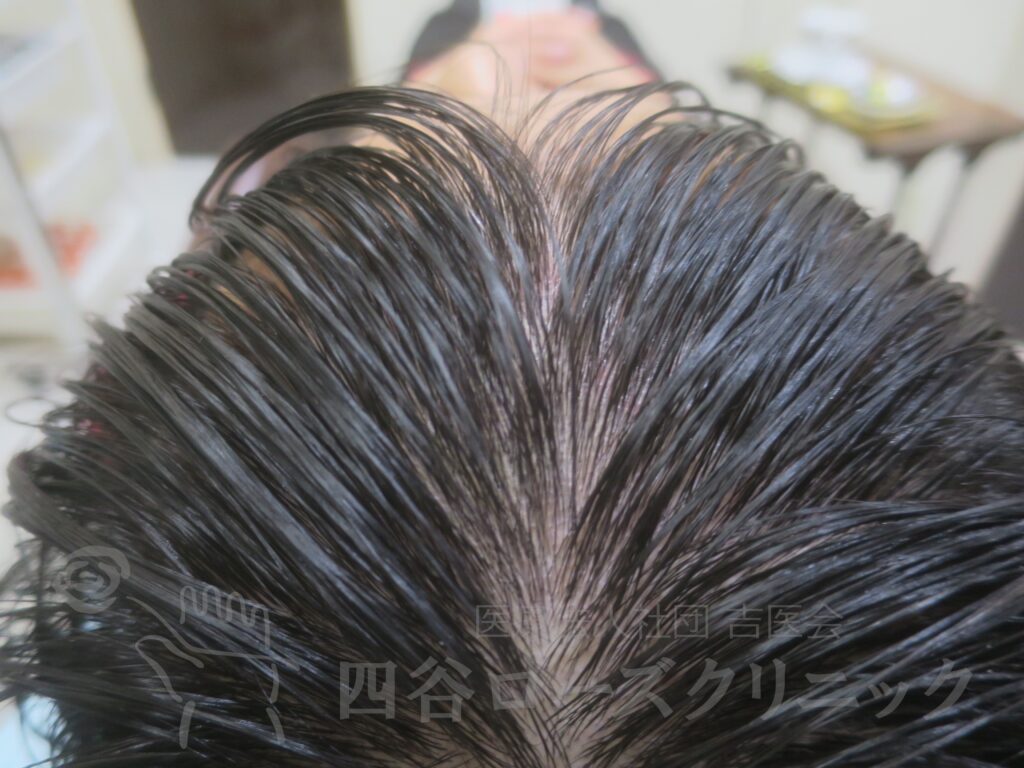 前頭部（進行度Ⅰ） 治療後
