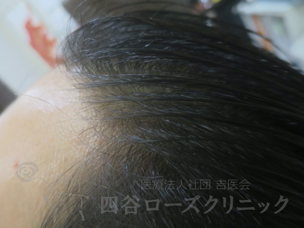 M字の食込み 治療後