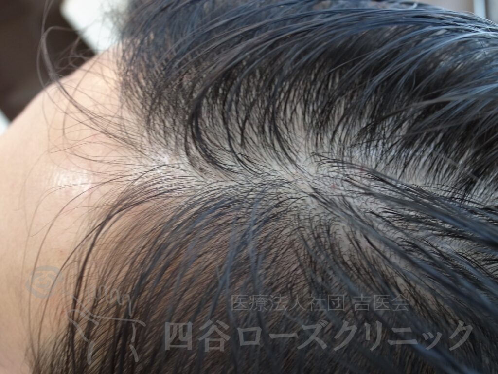M字の食込み 治療前
