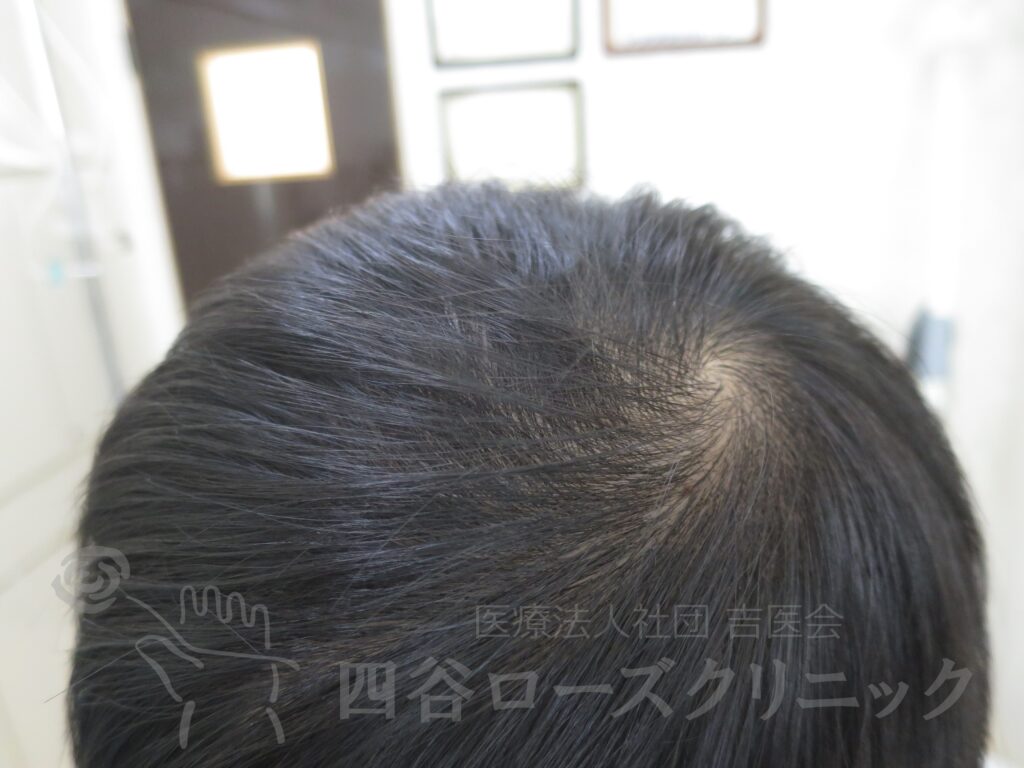 つむじの拡大 治療後