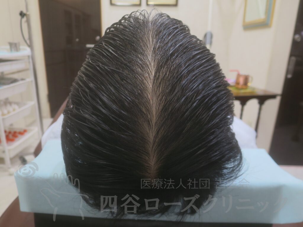 全頭（進行度Ⅲv） 治療後