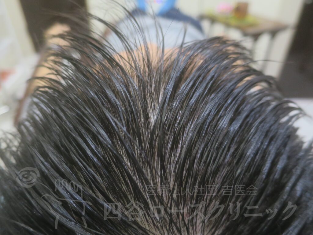 前頭部への進行 治療後