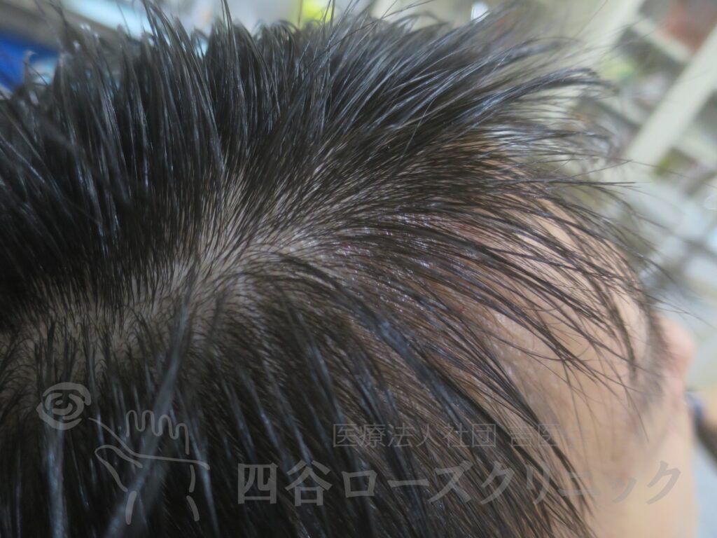 M字の食込み 治療後