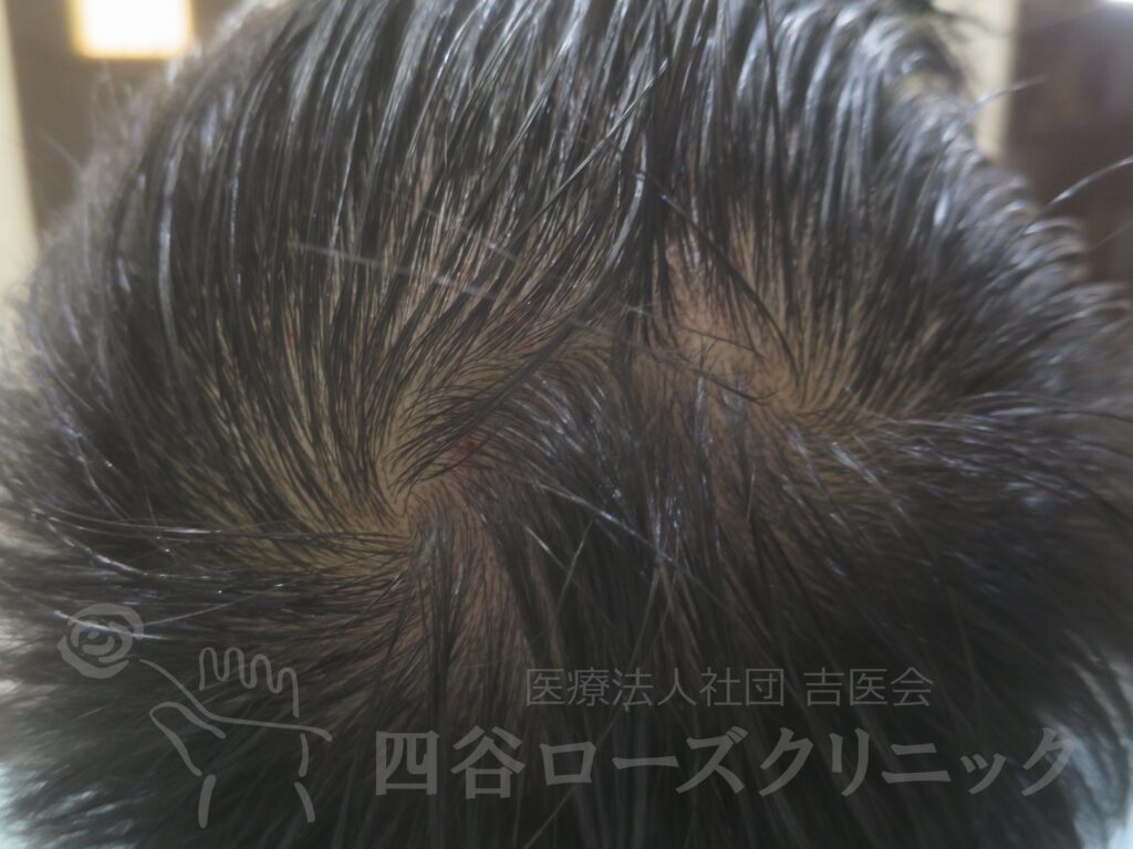つむじの拡大 治療後