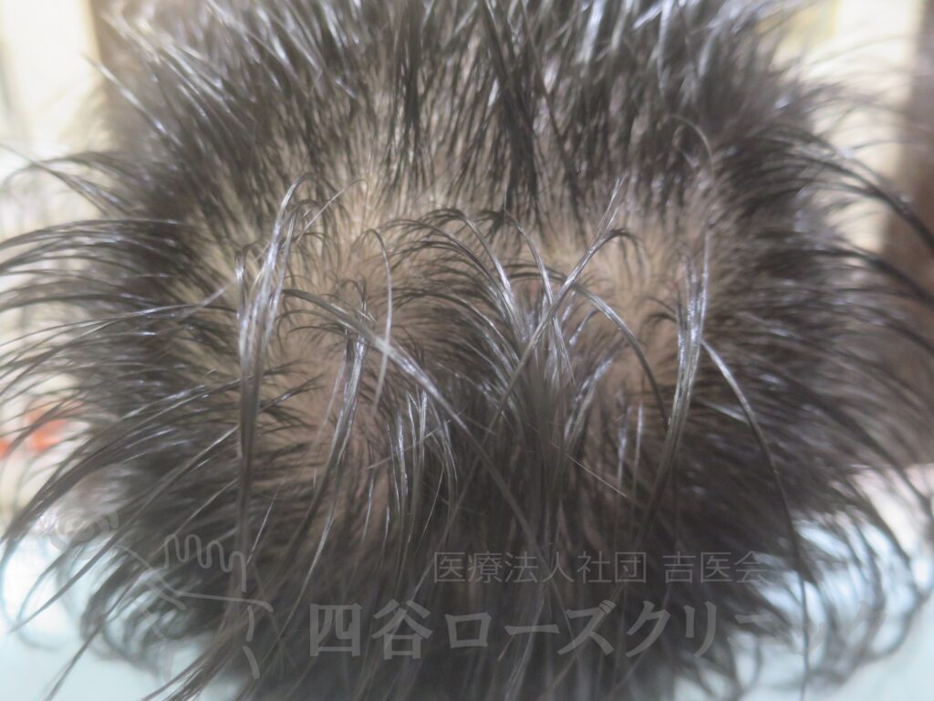 つむじの拡大 治療前