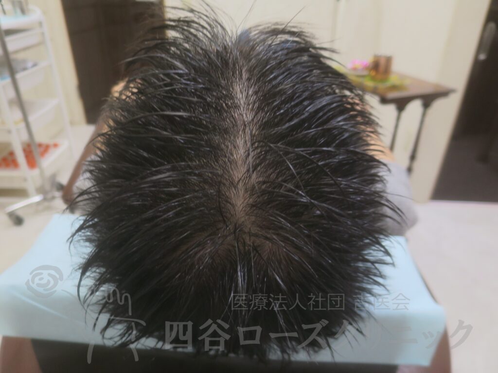 全頭（進行度Ⅲv） 治療後