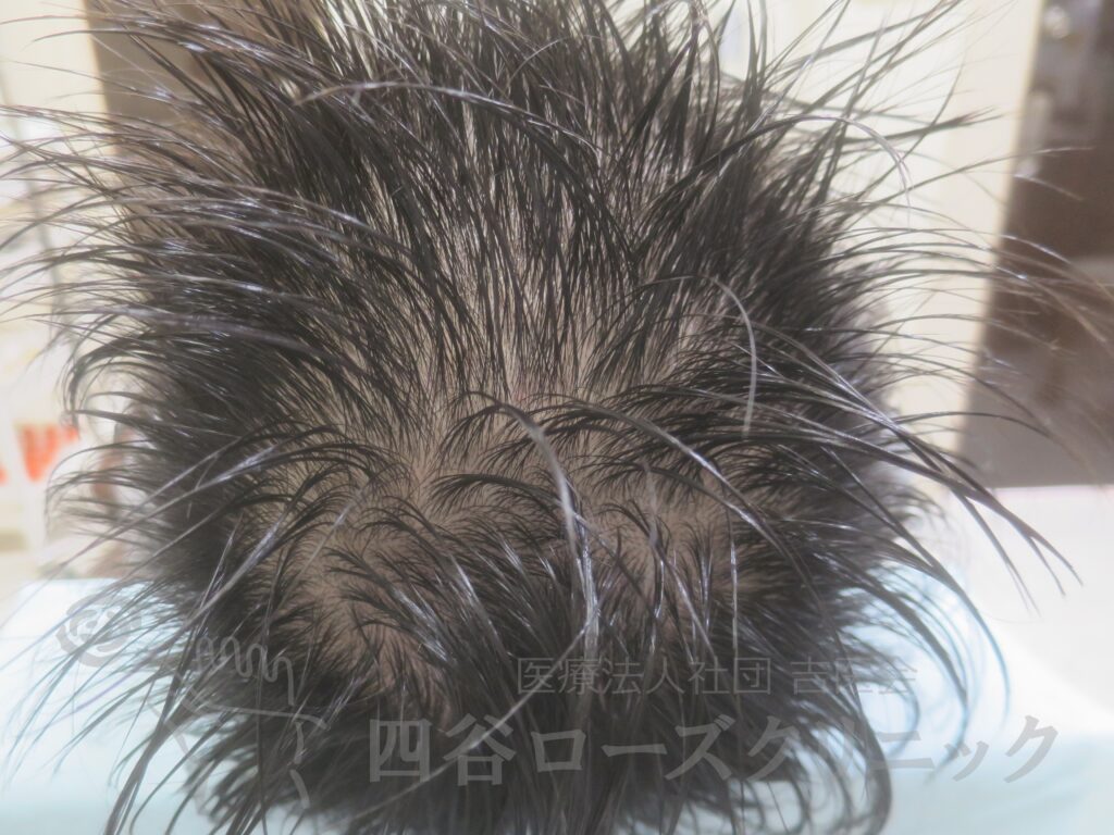 全頭（進行度Ⅲv） 治療前