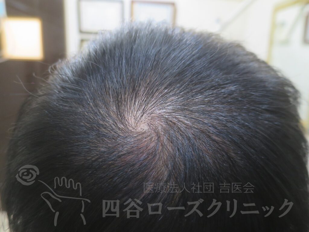 つむじの拡大 治療後