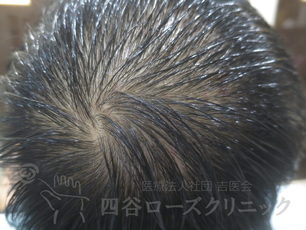 つむじの拡大 治療前