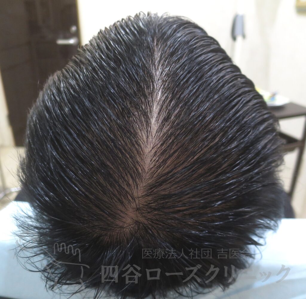 全頭（進行度Ⅲv） 治療後