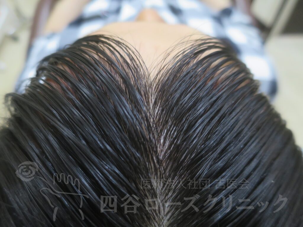前頭部（進行度Ⅰ） 治療後