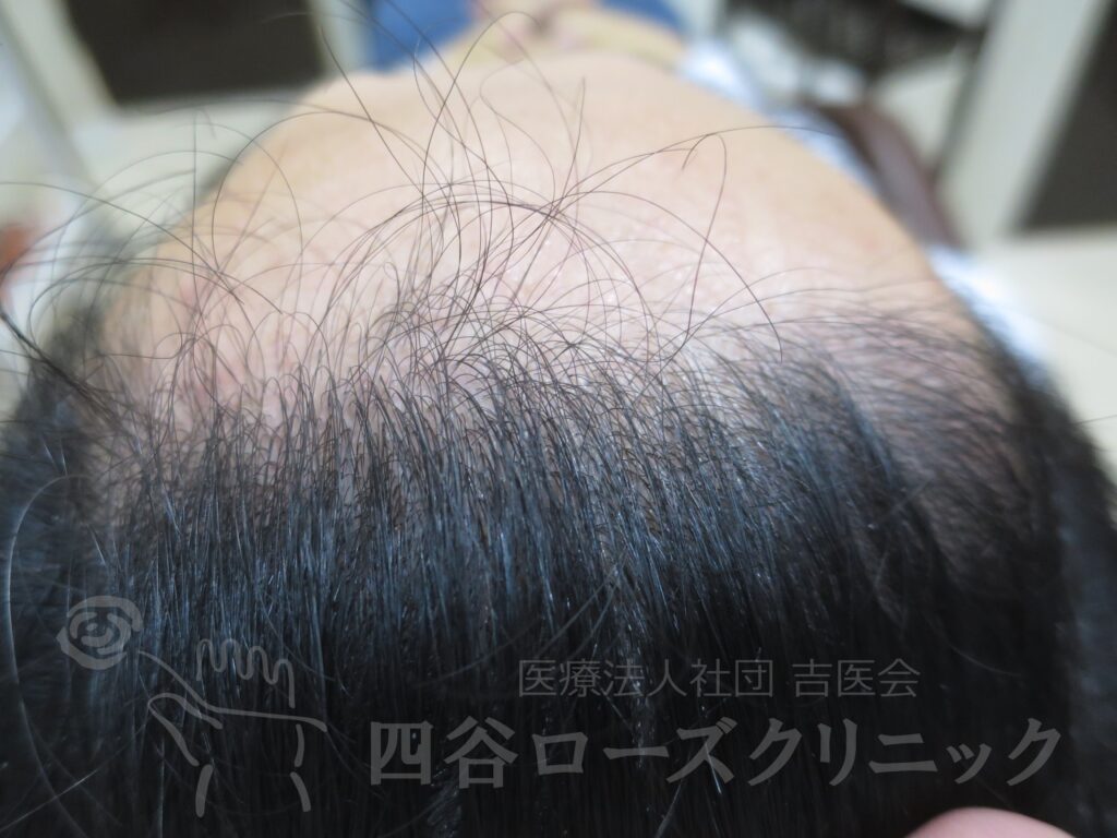 生え際の後退・上 治療後