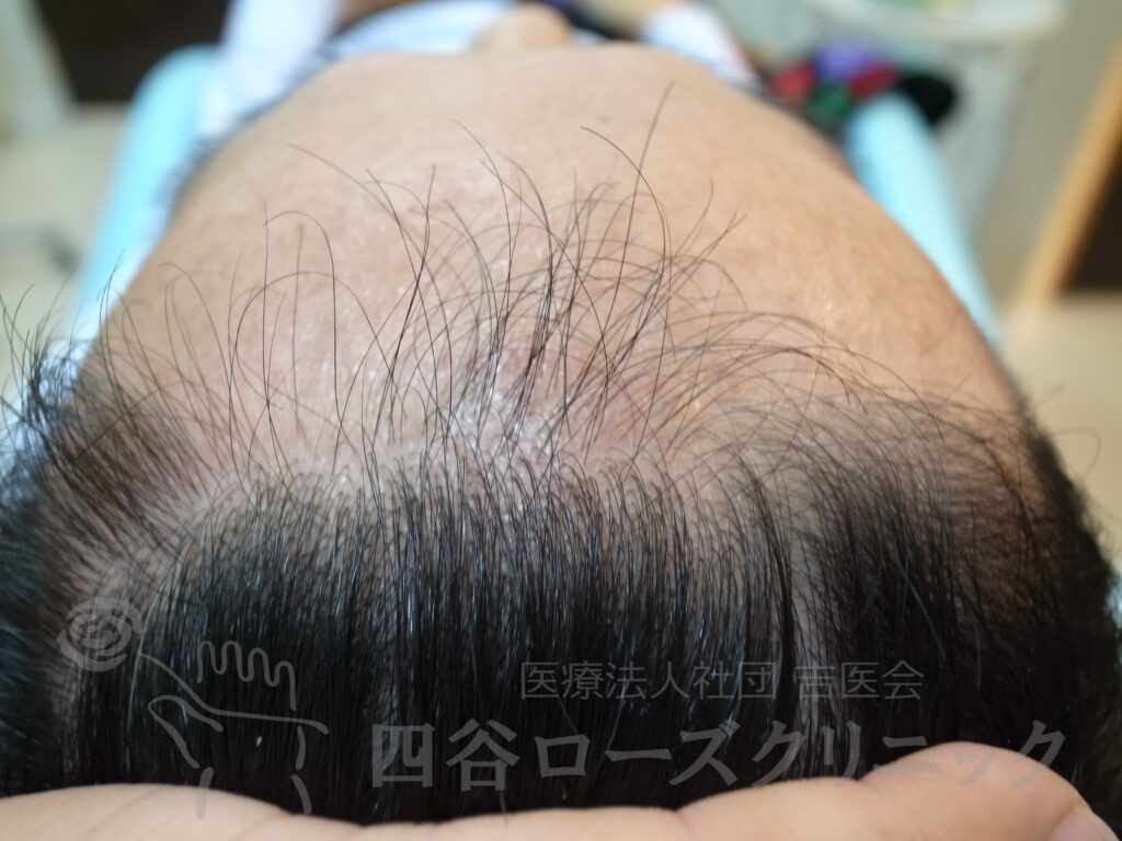 生え際の後退・上 治療前