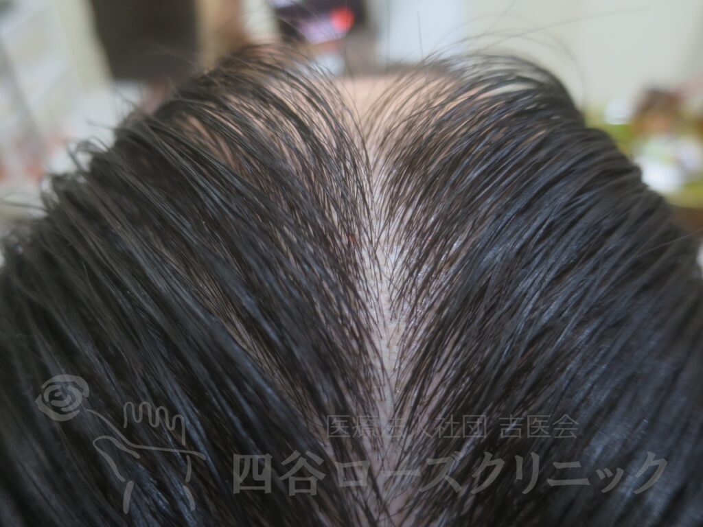 前頭部 治療後