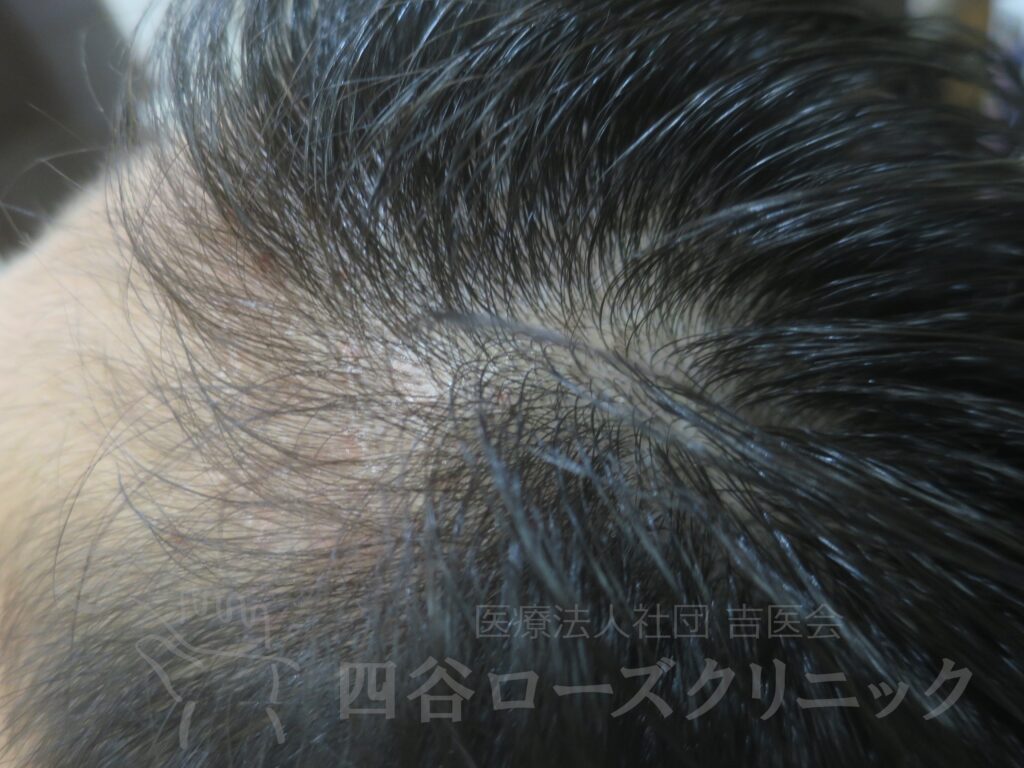 M字の食込み 治療前
