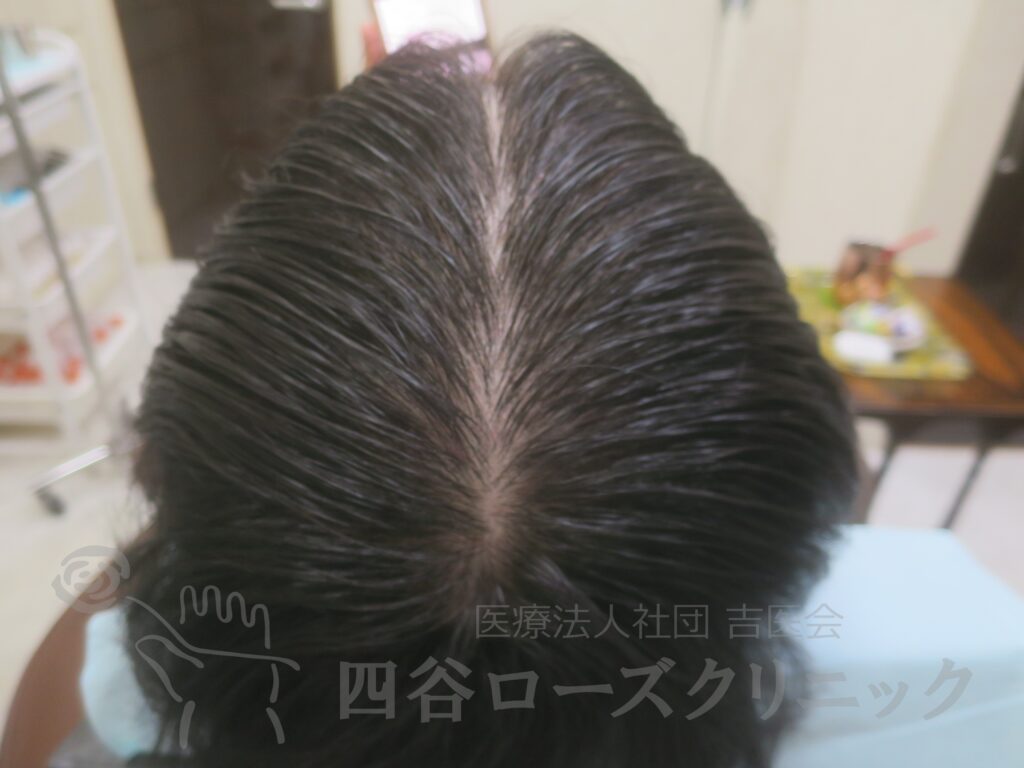 全頭（進行度Ⅱa） 治療後