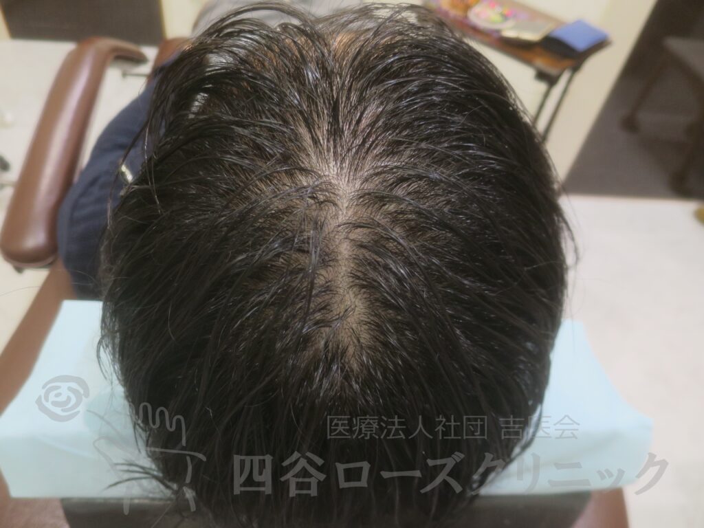 全頭（進行度Ⅱa） 治療前