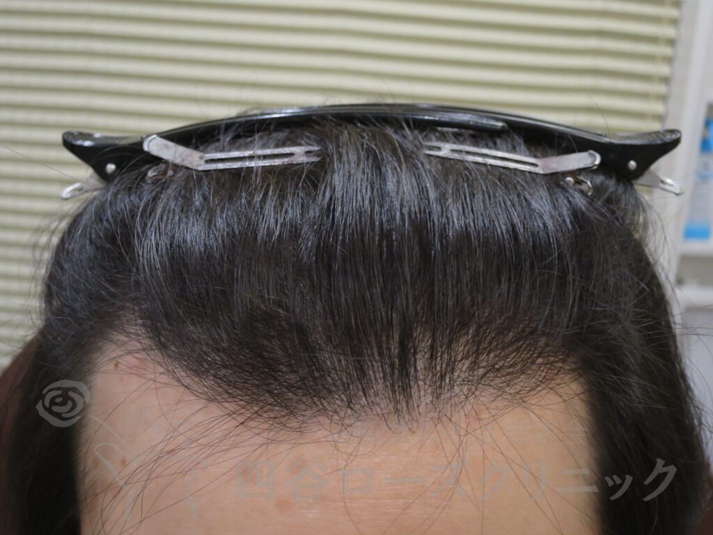 生え際の後退 治療後