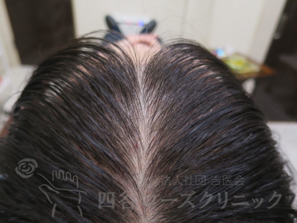前頭部 治療後
