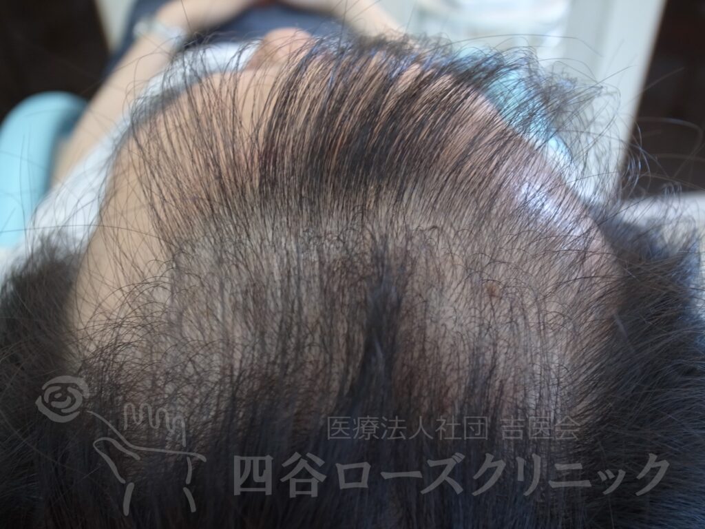 前頭部 治療前