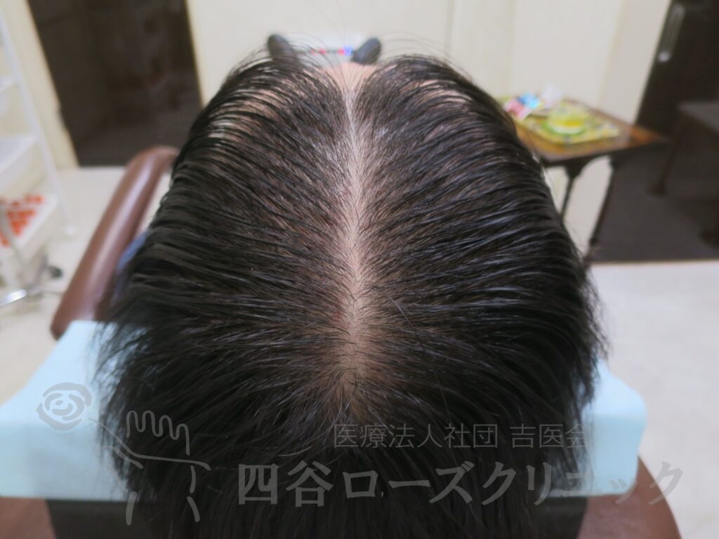 全頭（進行度Ⅲa） 治療後