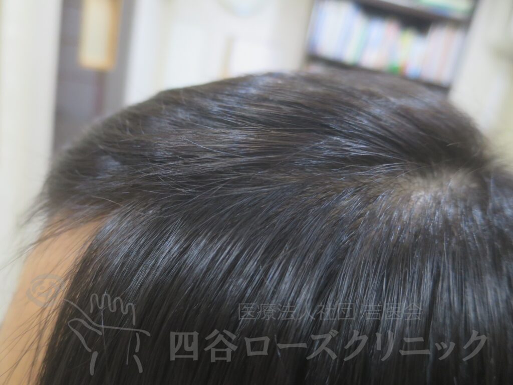 M字の食込み 治療後
