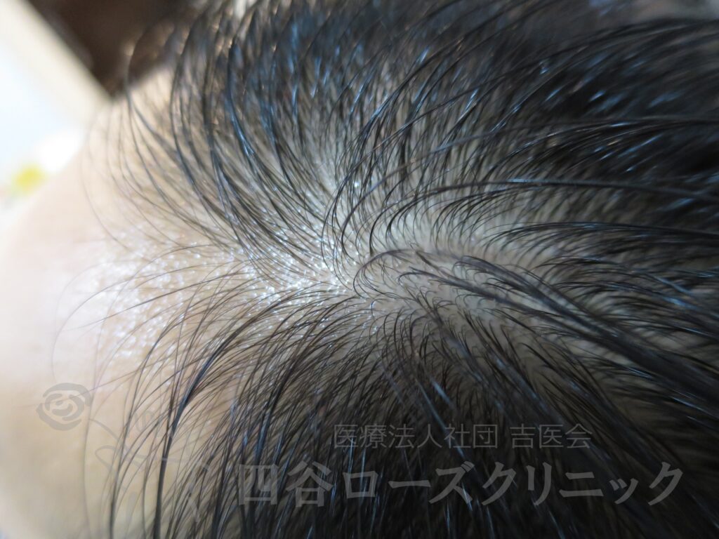 M字の食込み 治療前