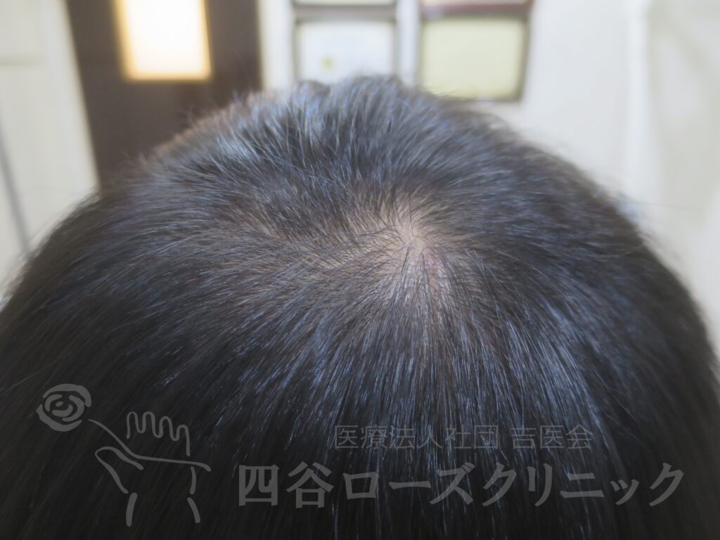 つむじの拡大 治療後