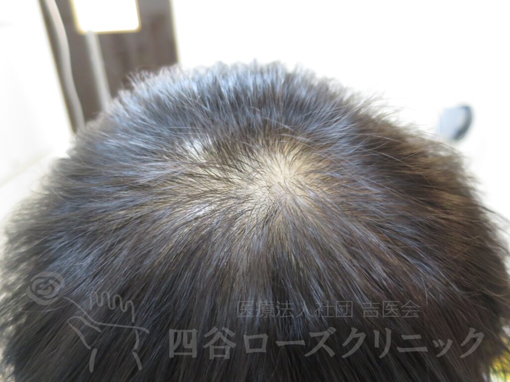 つむじの拡大 治療前