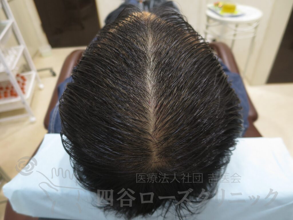 全頭（進行度Ⅳa） 治療後