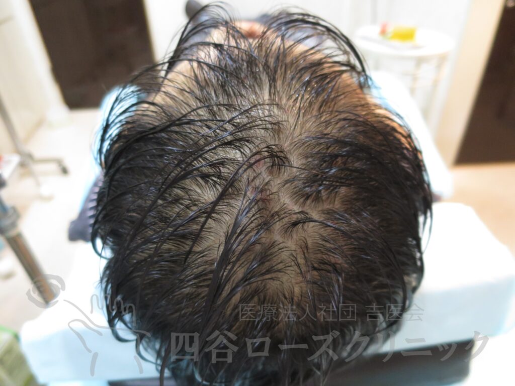 全頭（進行度Ⅳa） 治療前