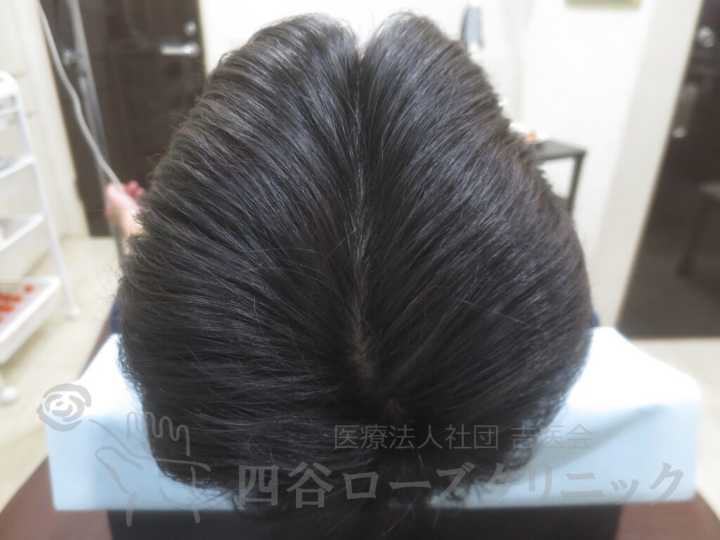 全頭（進行度Ⅱ） 治療後
