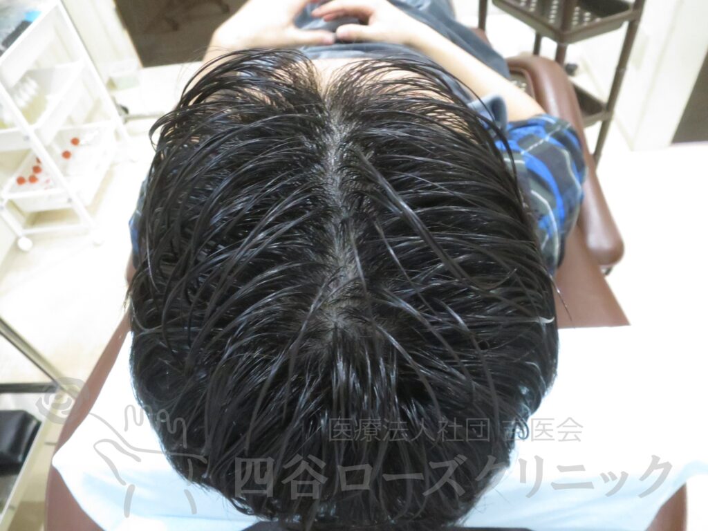 全頭（進行度Ⅱ） 治療前
