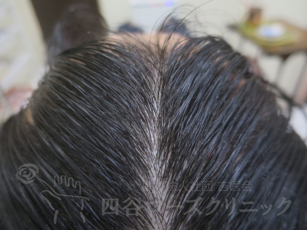 前頭部 治療後