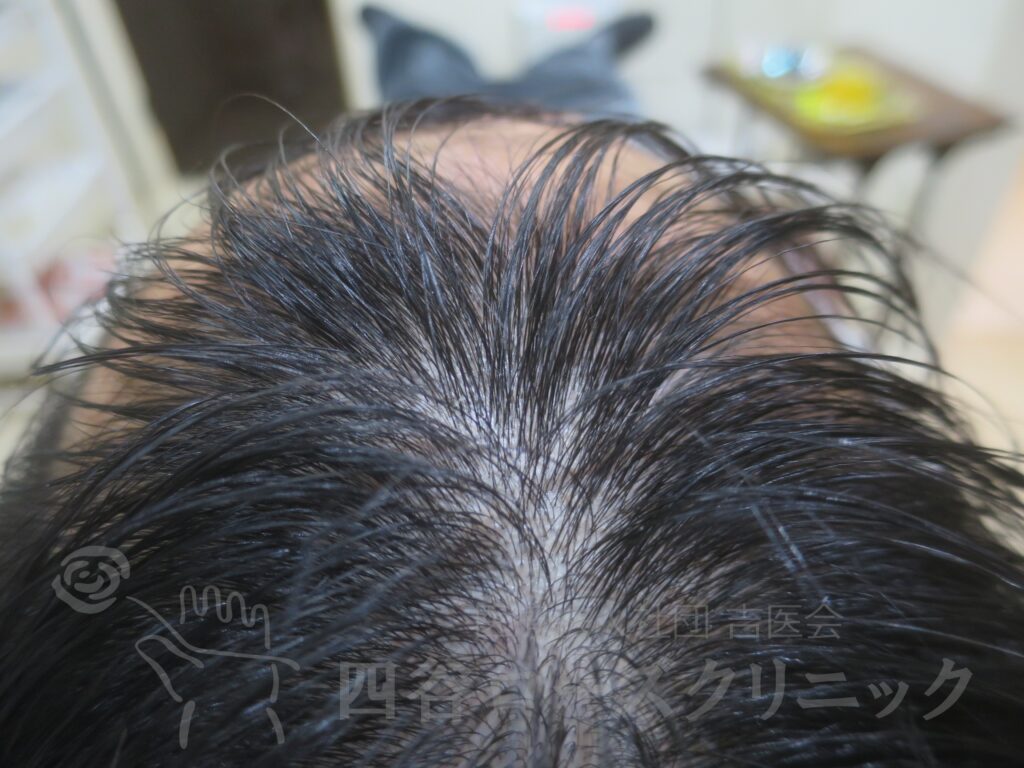 前頭部 治療前