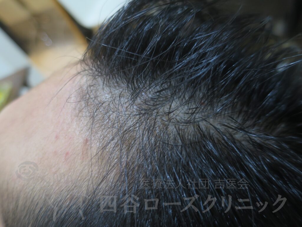 M字の食込み 治療前