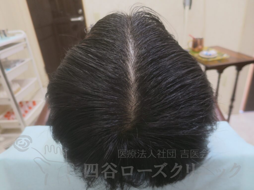 全頭（進行度Ⅱ） 治療後