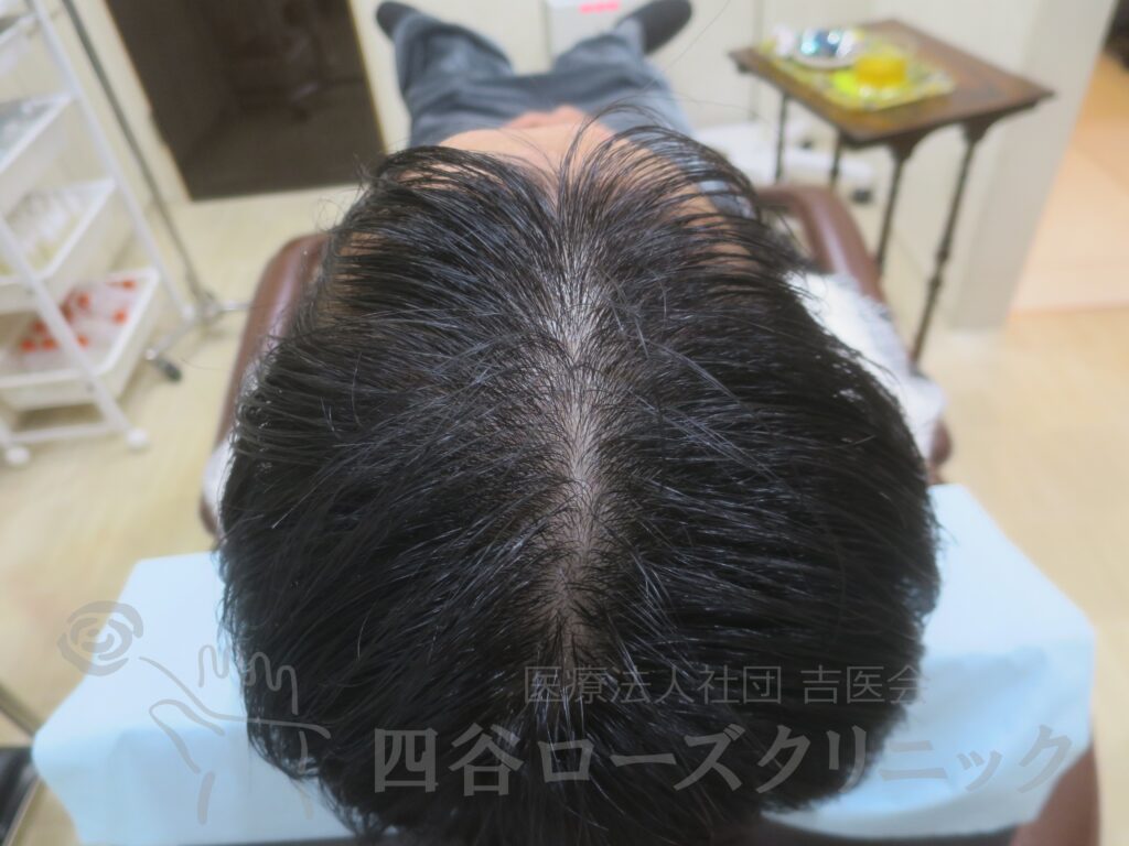全頭（進行度Ⅱ） 治療前