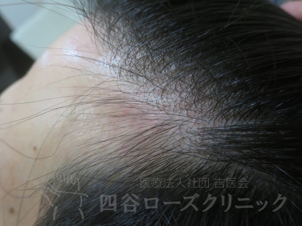 M字の食込み 治療前