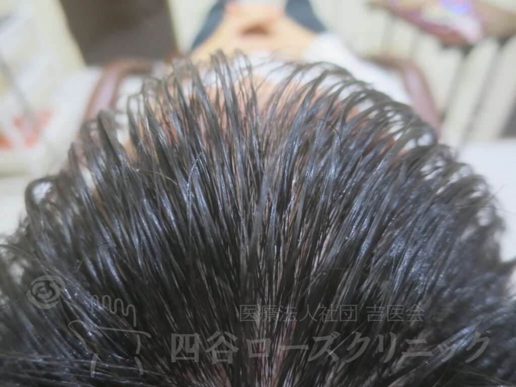 前頭部（進行度Ⅰ） 治療後