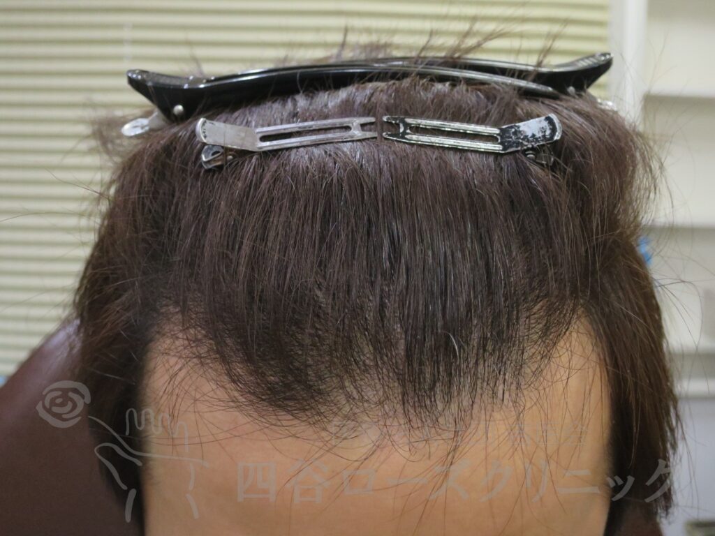 生え際の後退 治療後