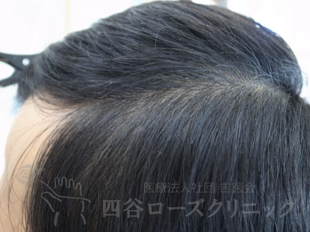 側頭部 治療後