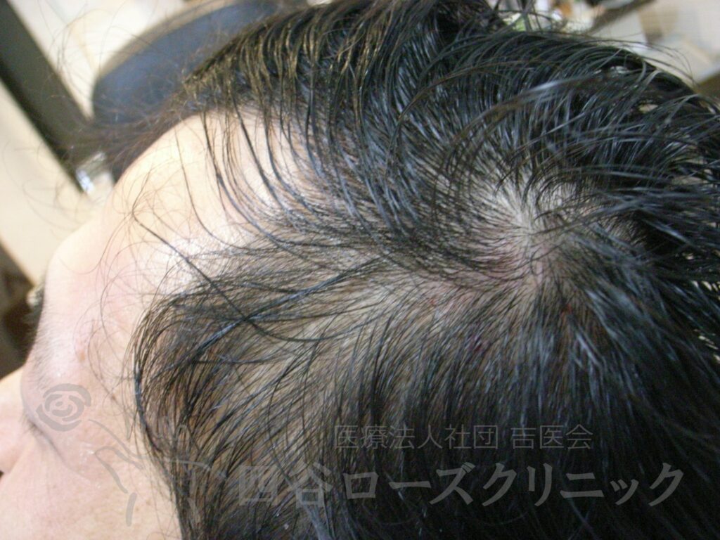 側頭部 治療前