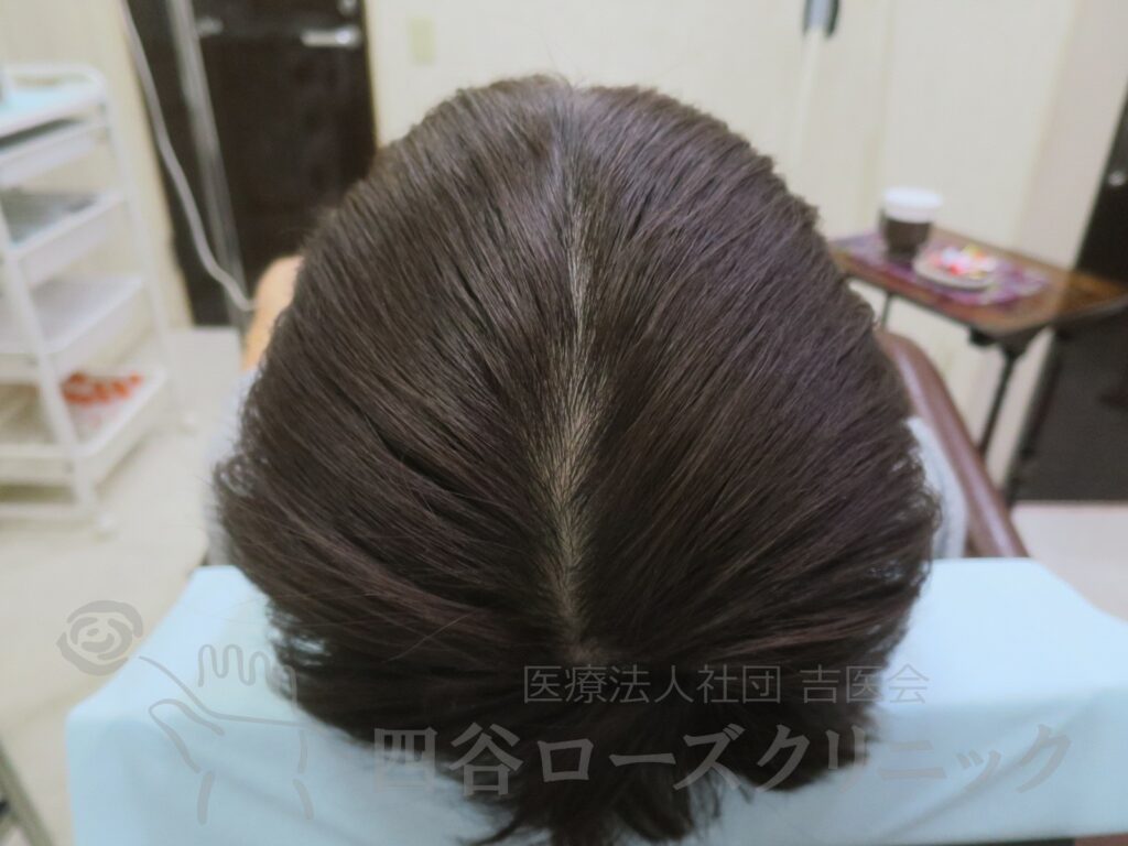 全頭（進行度Ⅲa） 治療後