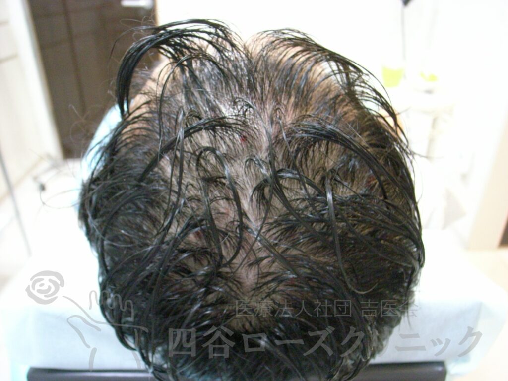 全頭（進行度Ⅲa） 治療前