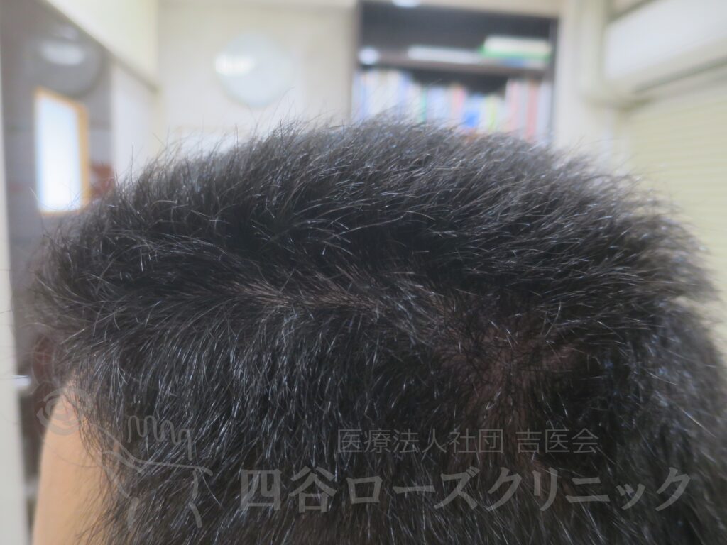 M字の食込み 治療後